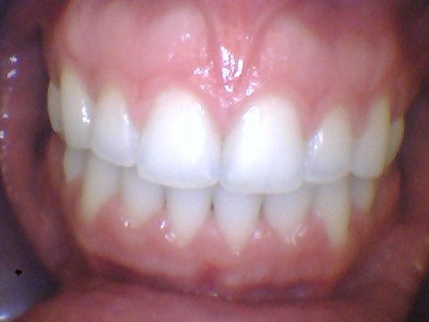 Closed gap between front teeth