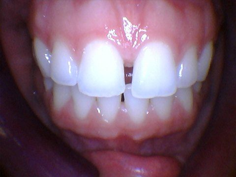 Gap between front teeth