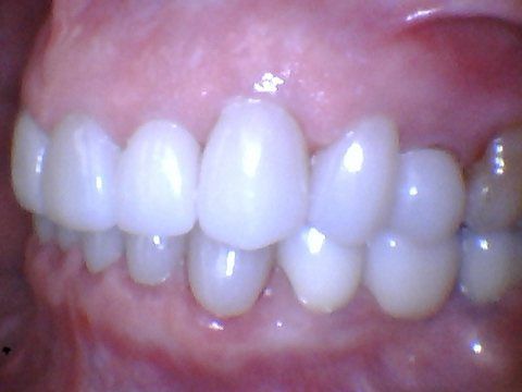 Aligned smile after treatment