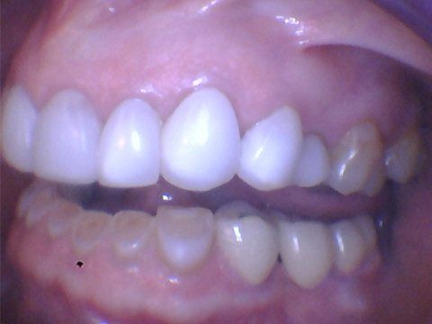 Crooked teeth before treatment