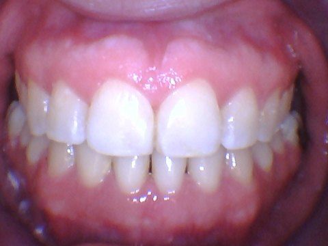 Large gaps between bottom teeth