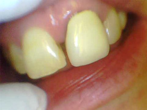 Yellow uneven spaced teeth