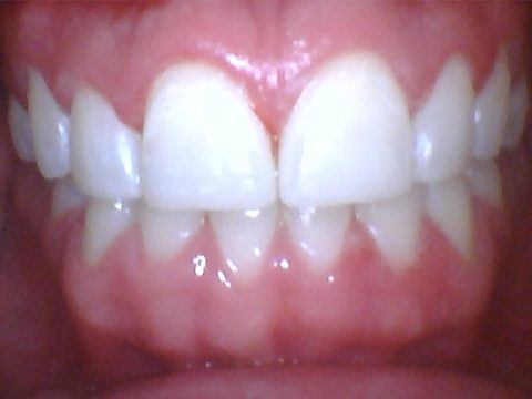 Healthy beautiful smile after treatment