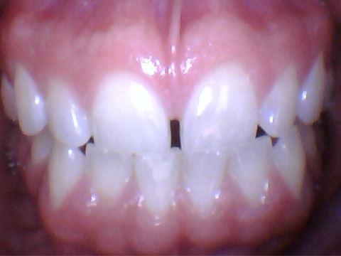 Stubby teeth with large spacing