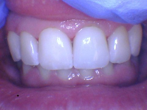 Flawless smile after treatment