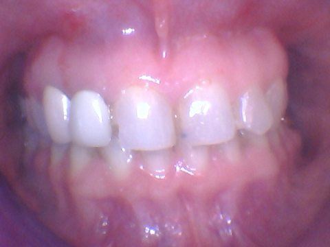 Irregularly shaped teeth before treatment