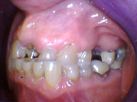 Severely decayed and damaged smile