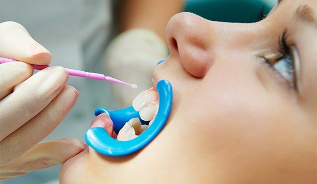 Child receiving fluoride treatment