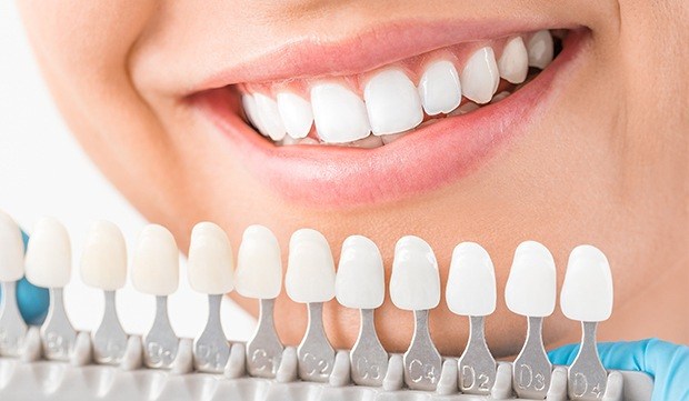 Smile compared with tooth color chart