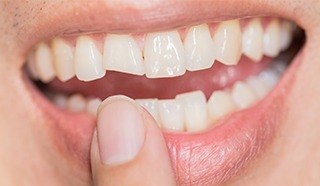 Closeup of smile with chipped front tooth