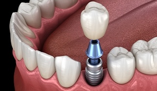Animated implant supported dental crown placement