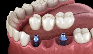 Animated implant supported fixed bridge placement