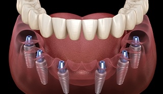 Animated implant supported denture placement