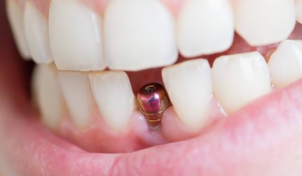 Smile with dental implant visible