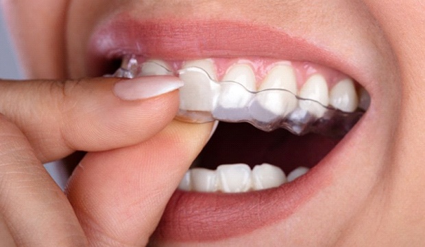 person with Invisalign clear braces
