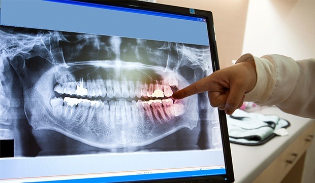 Panoramic dental x-rays